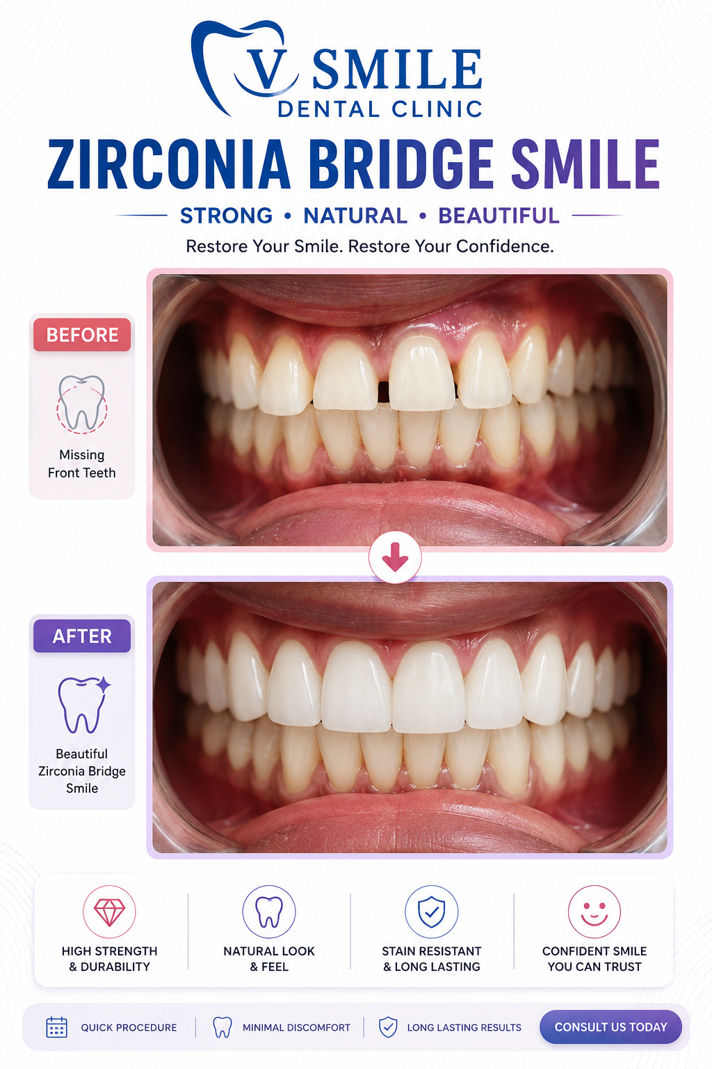 Zirconia bridge before and after — missing front teeth restored