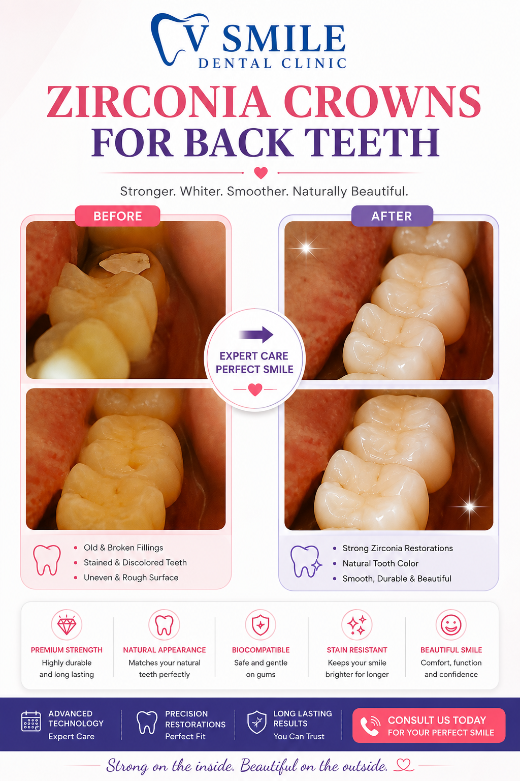 Zirconia crowns for back teeth before and after
