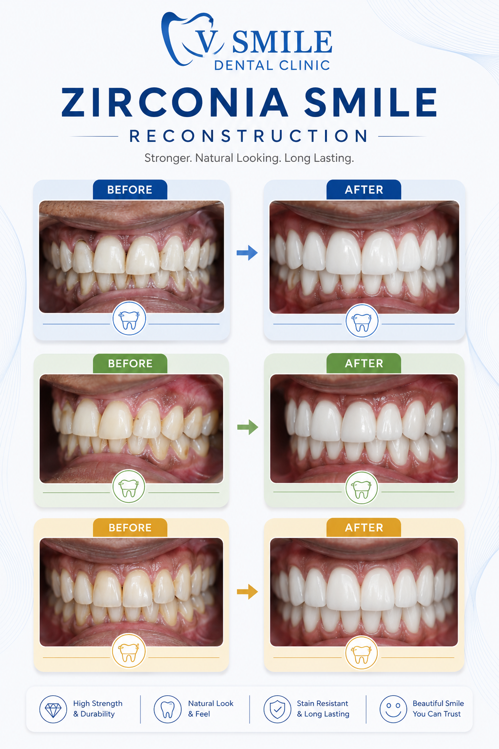 Zirconia smile reconstruction before and after