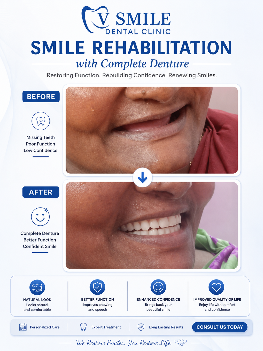 Complete denture smile rehabilitation before and after