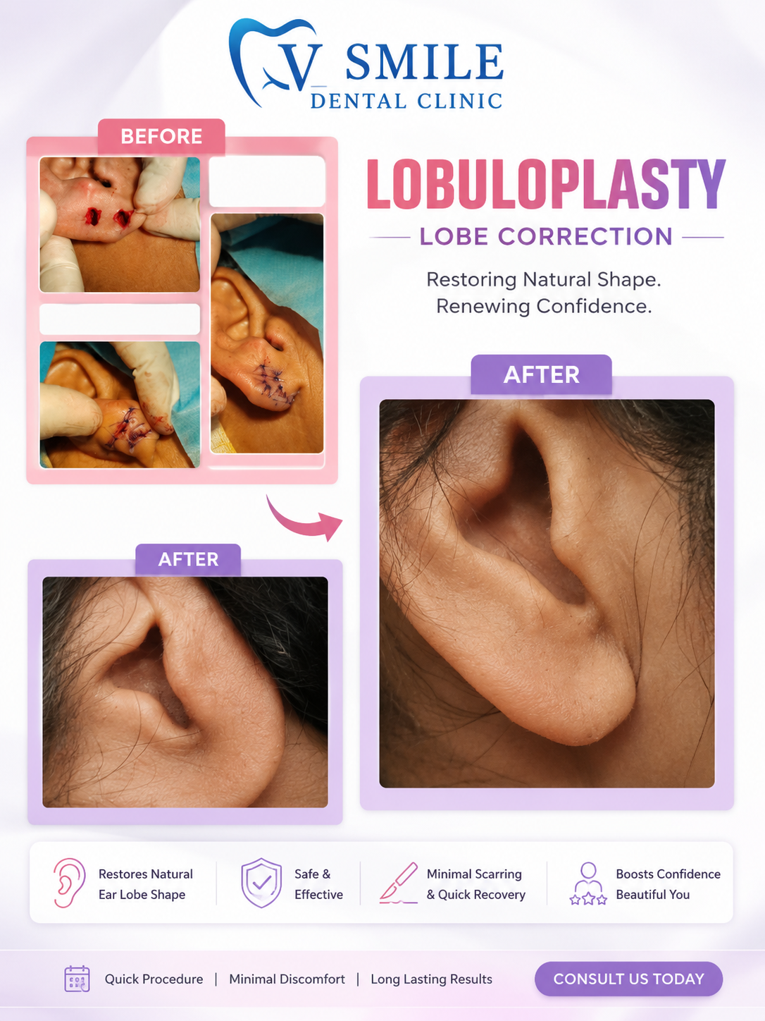 Lobuloplasty ear lobe correction before and after