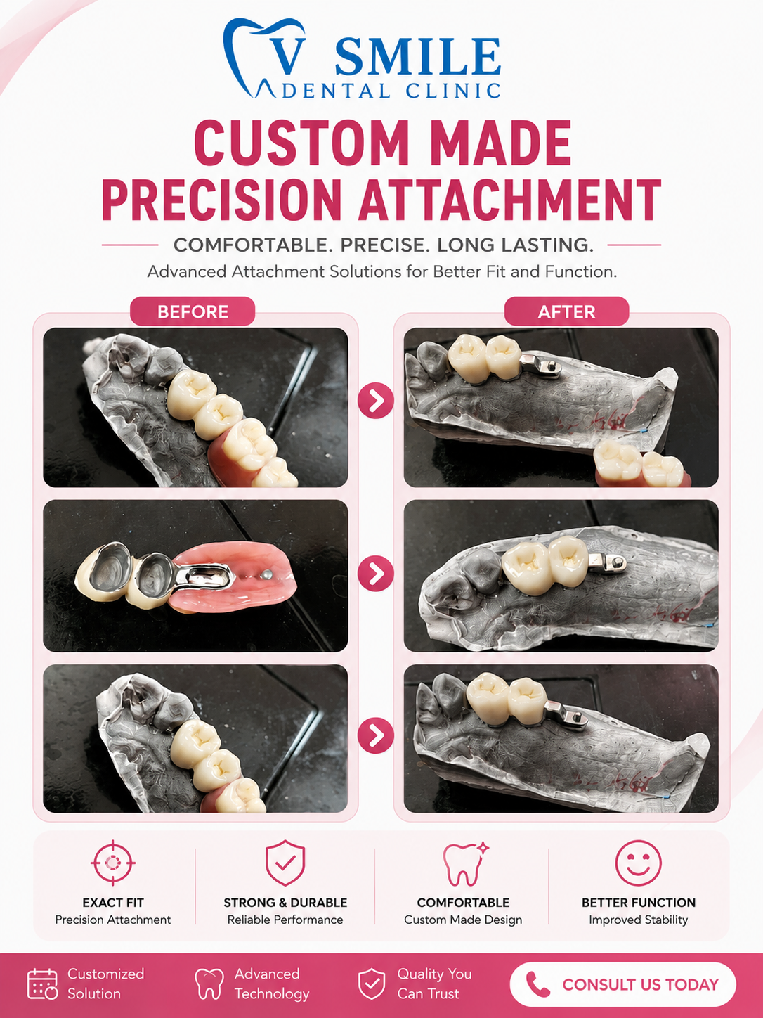 Custom made precision attachment before and after