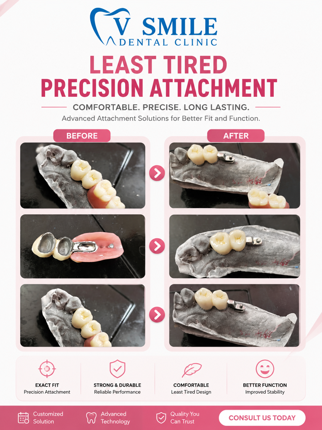 Precision dental restoration work at V Smile Dental Clinic