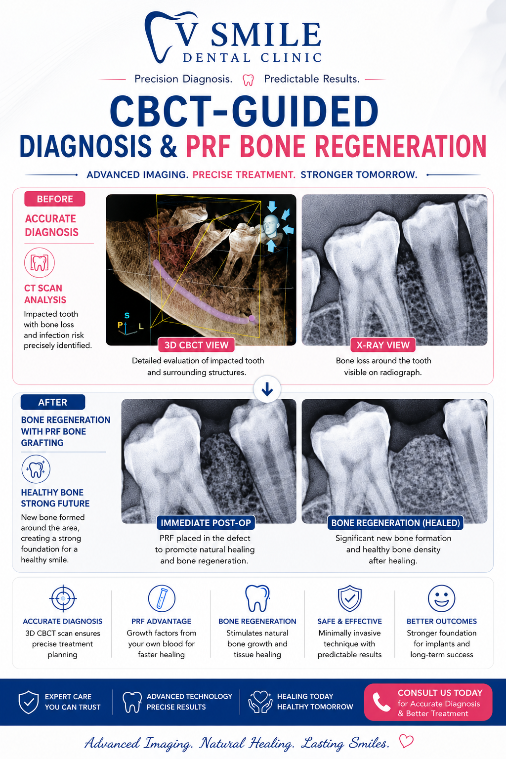 CBCT-guided diagnosis and PRF bone regeneration