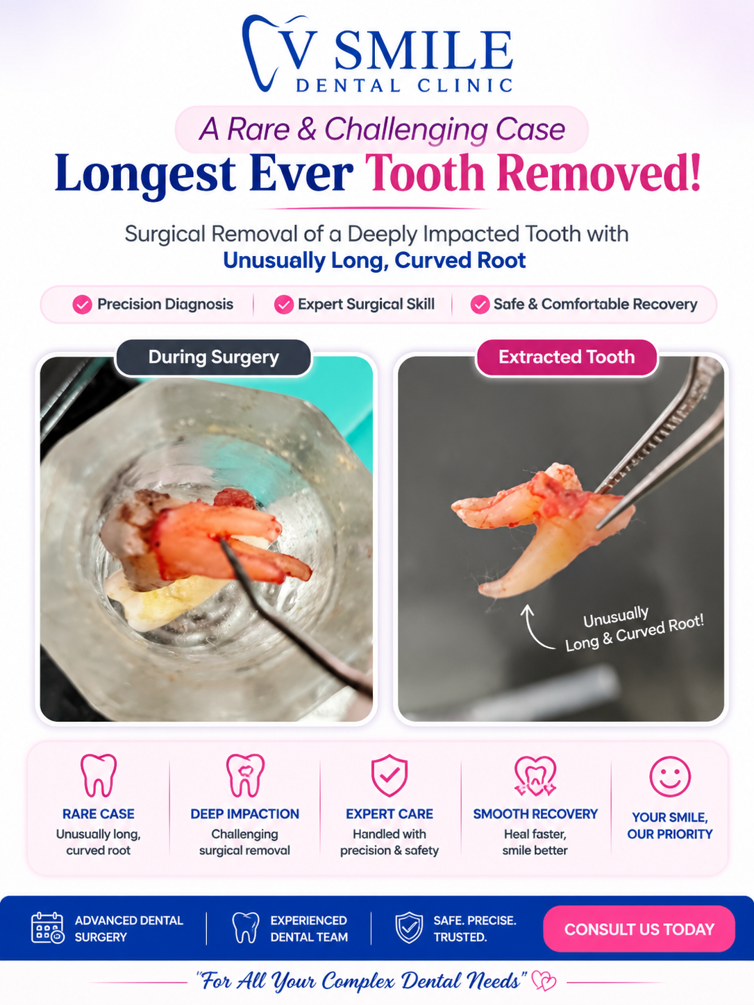Rare case — surgical removal of a deeply impacted tooth with an unusually long, curved root